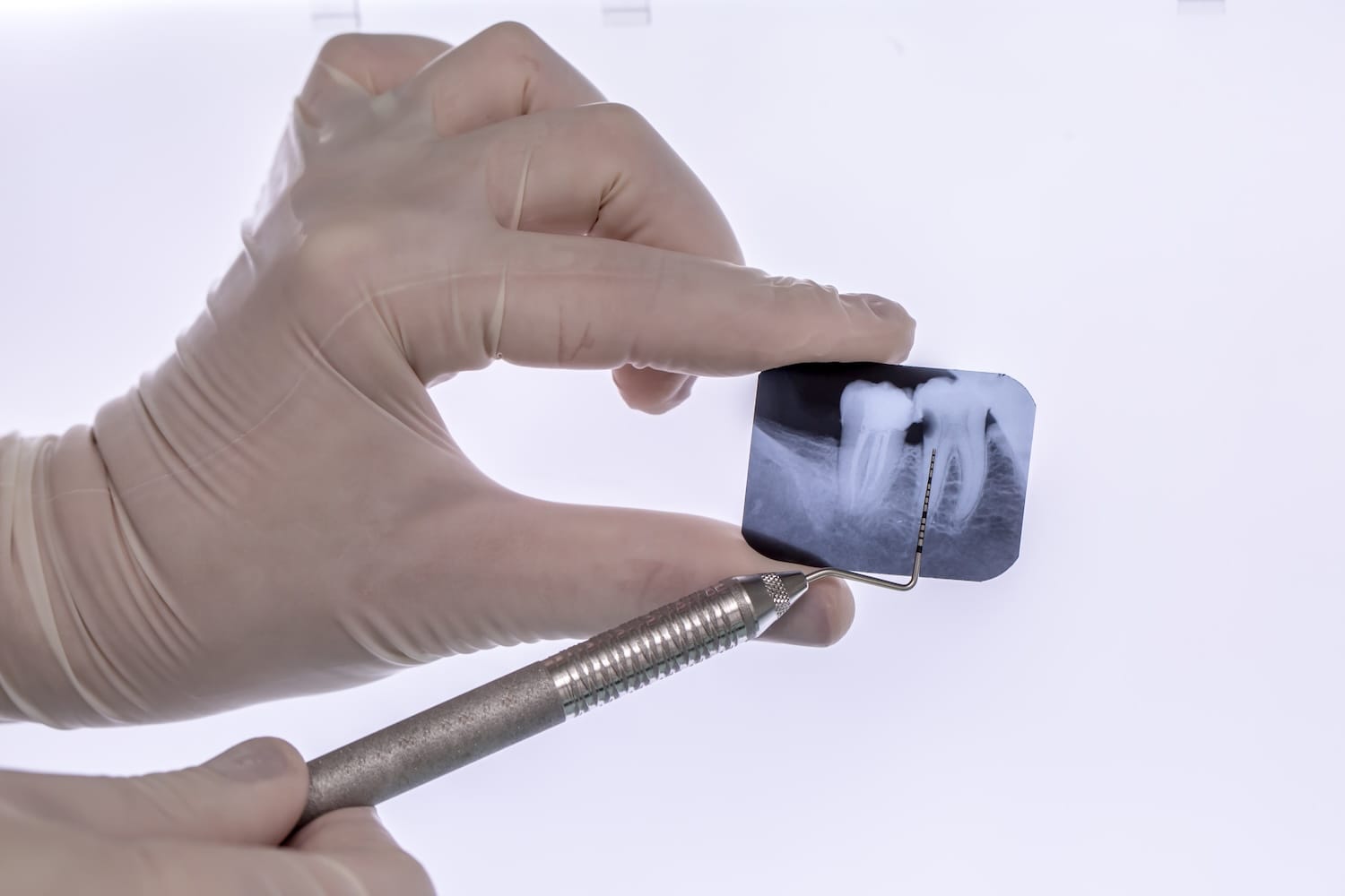 carga inmediata en implantes