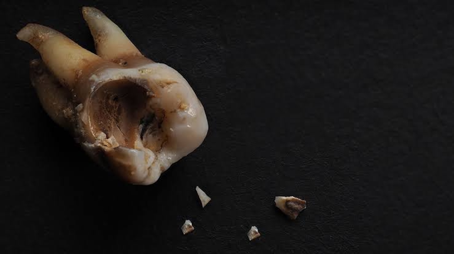 caries radicular